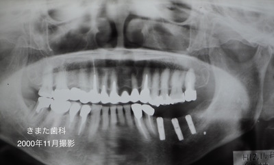 きまた歯科インプラント1.jpg