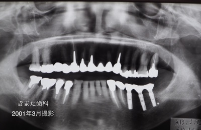 きまた歯科インプラント2.jpg