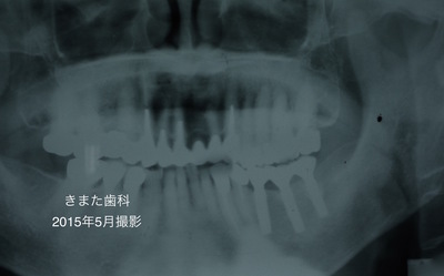 きまた歯科インプラント3.jpg