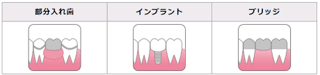 義歯.png